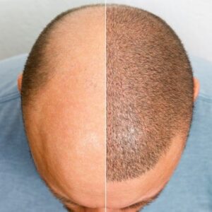 calvície e soluções